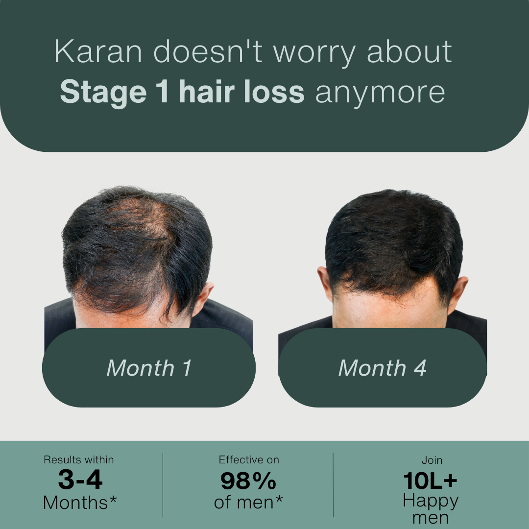 Hair Fall Stage 1: The Starter Kit